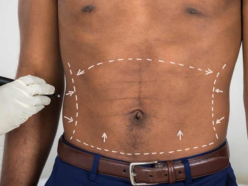 Abdominoplastia